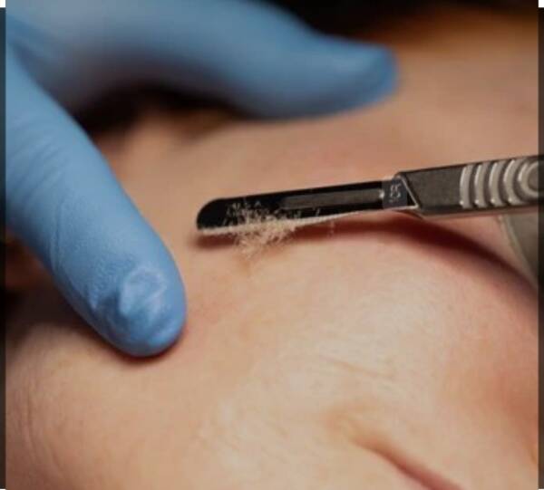Dermaplaning